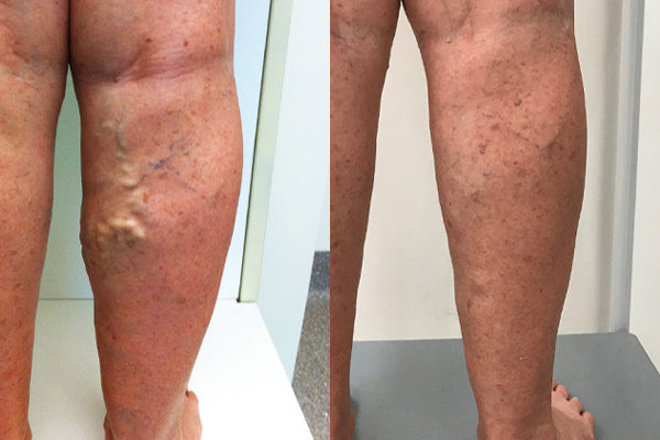 🔥Last 4 Hours 70% OFF✨AQA™ Vein Guard Herbal Spray