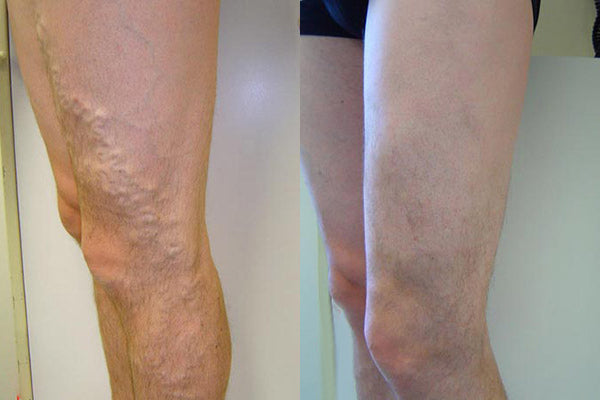 🔥Last 4 Hours 70% OFF✨AQA™ Vein Guard Herbal Spray
