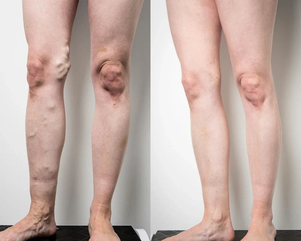 🔥Last 4 Hours 70% OFF✨AQA™ Vein Guard Herbal Spray