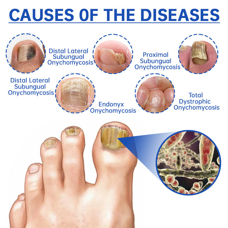 QIAWI™ PureNail Fungus Laser Device-✨Last Day Discount -𝟕0%𝐎𝐅𝐅 Made and Shipped from USA