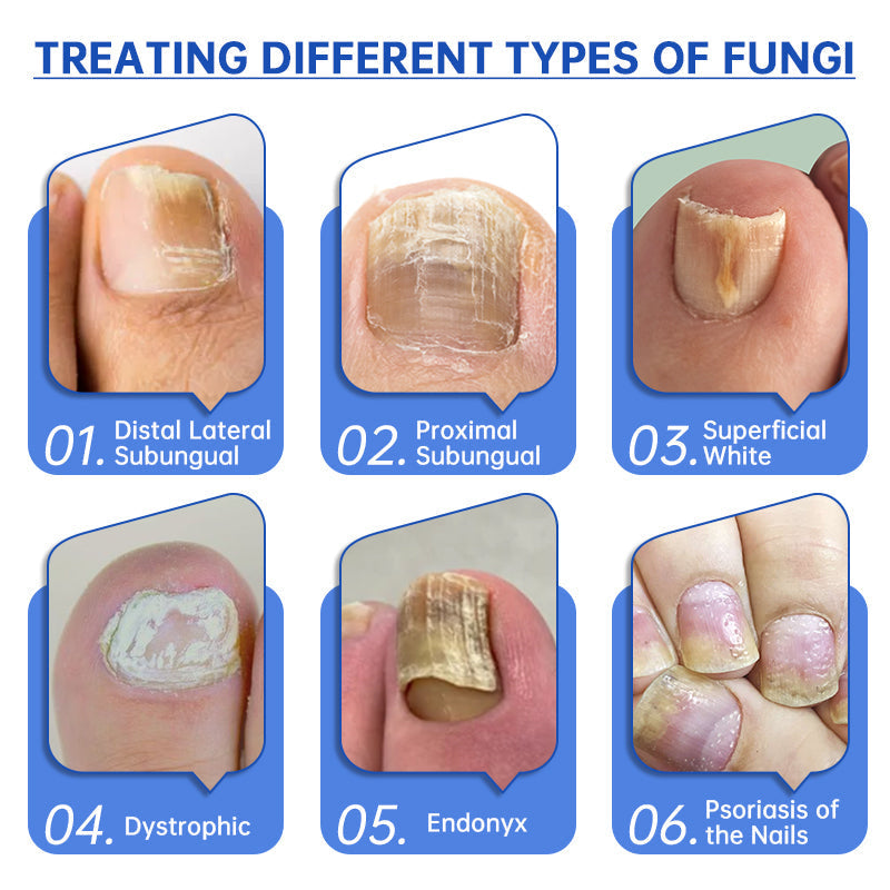 QIAWI™ PureNail Fungus Laser Device-✨Last Day Discount -𝟕0%𝐎𝐅𝐅 Made and Shipped from USA