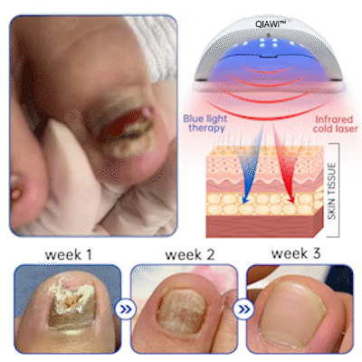 QIAWI™ PureNail Fungus Laser Device-✨Last Day Discount -𝟕0%𝐎𝐅𝐅 Made and Shipped from USA
