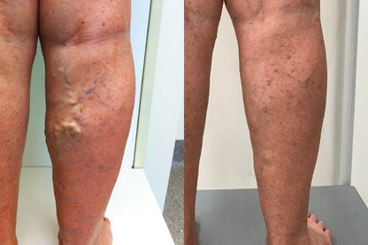 🔥Last 4 Hours 70% OFF✨AQA™ Vein Guard Herbal Spray